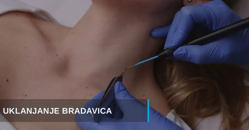 Uklanjanje bradavica radio-talasima poliklinika Diva dr Bogdanović Beograd